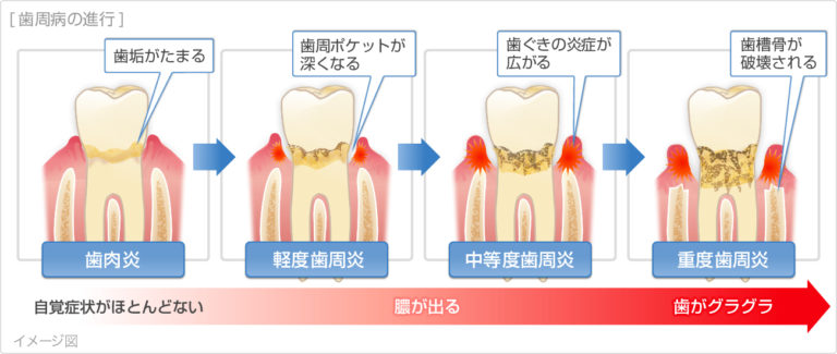 重曹でブラッシングする